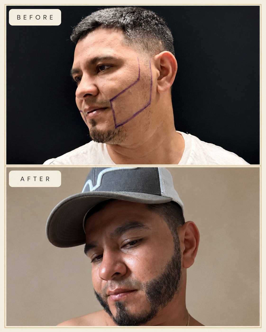 Beard transplant patient before and after showing fuller beard density