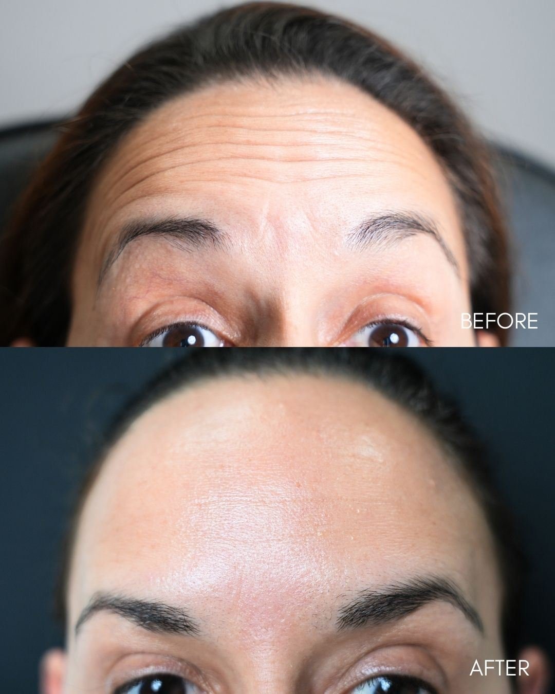 Before and after of Botox on forehead lines showing smooth natural result