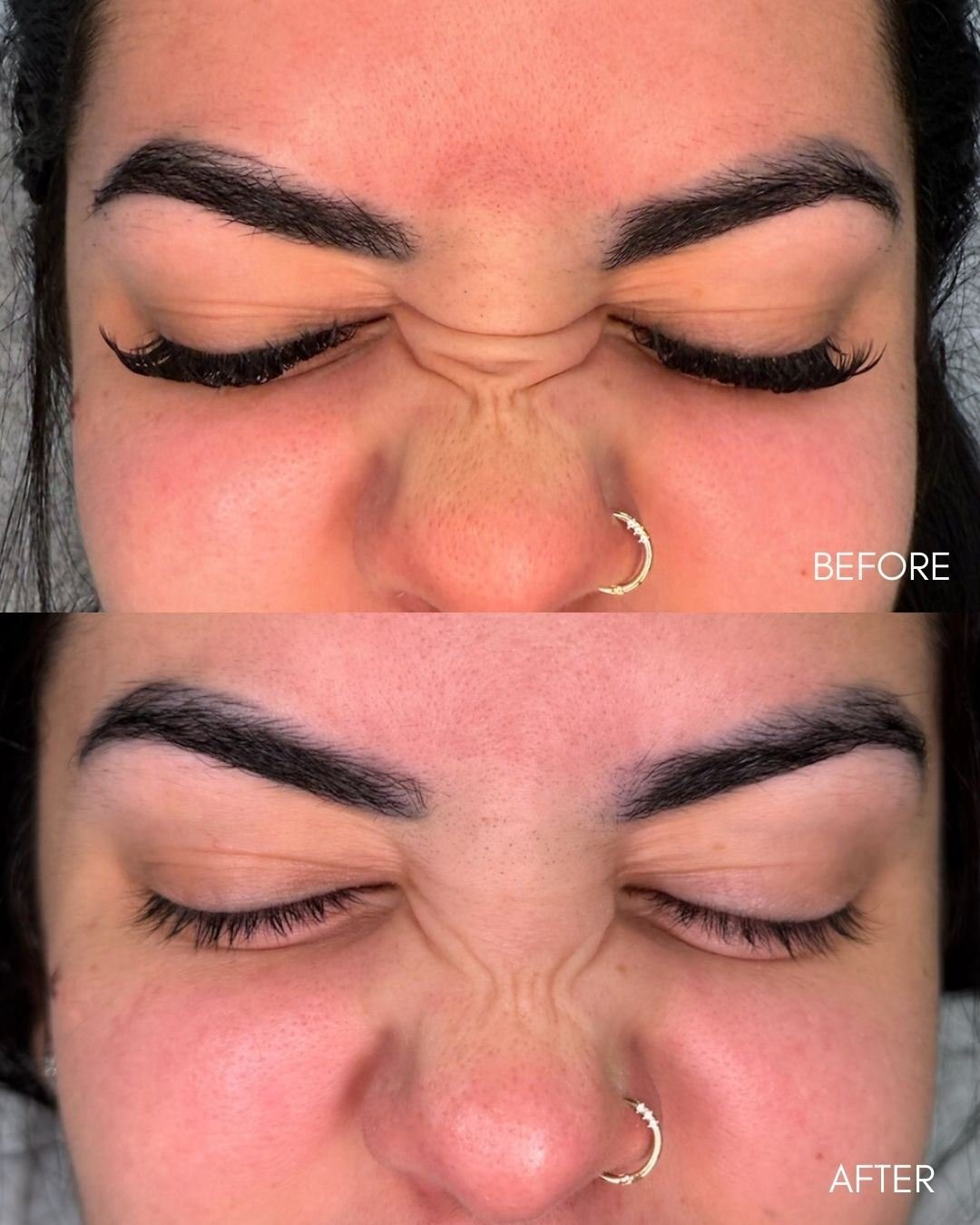 Before and after of Botox on bunny lines around the nose