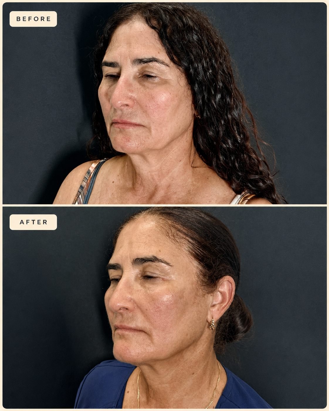 Before and after of Endolaser skin tightening at The Edit