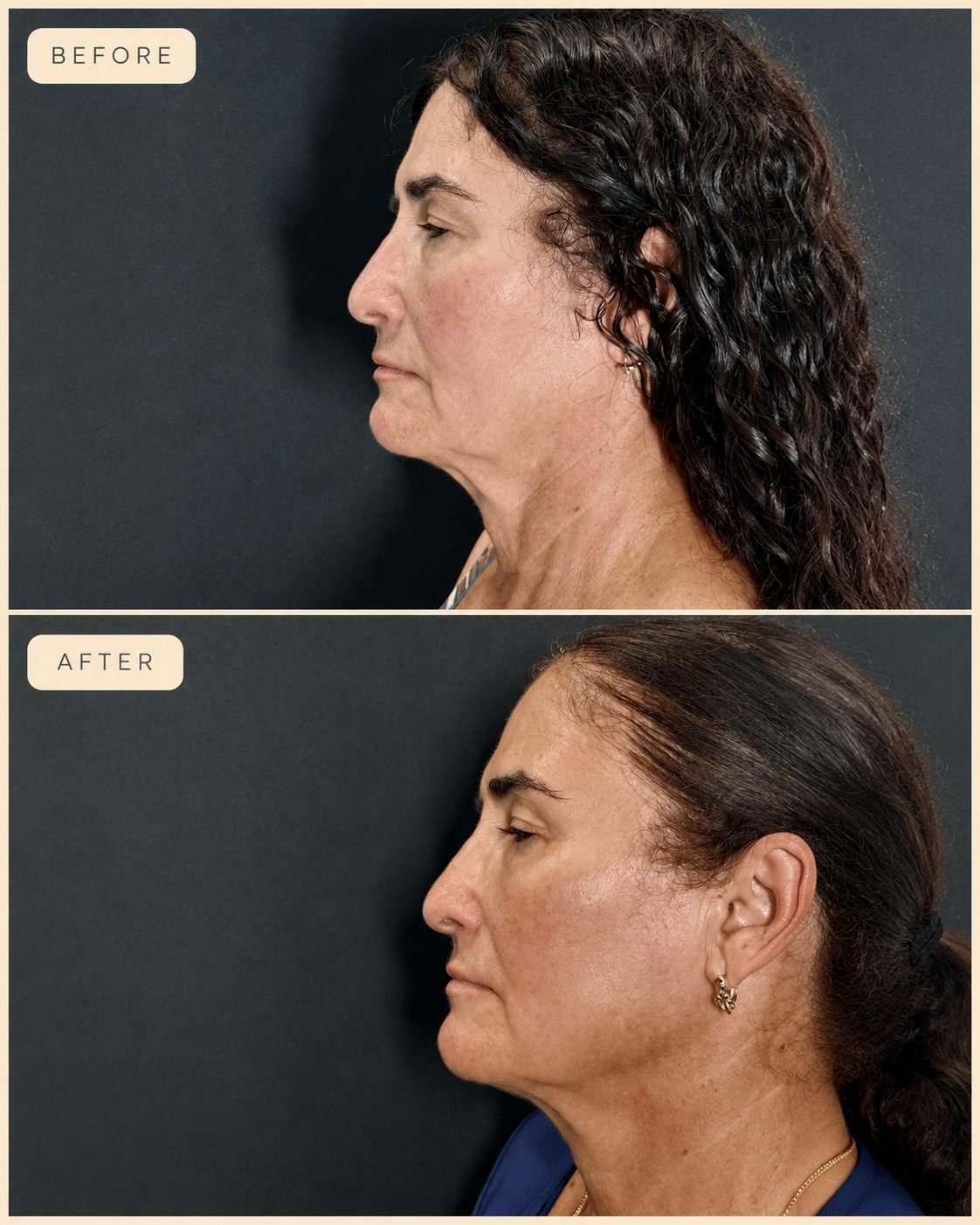 Before and after of an Endolaser definition case at The Edit