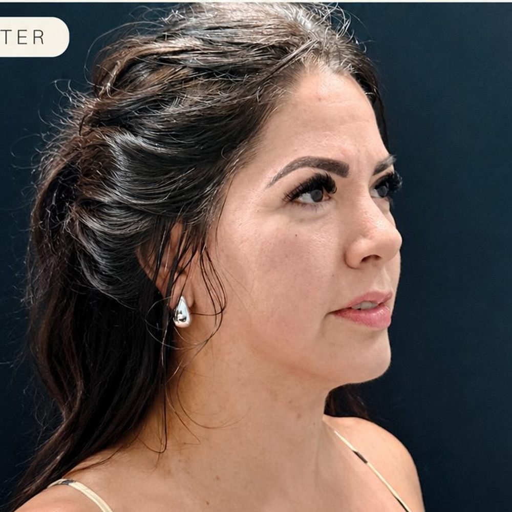 Side profile after Endolaser with reduced double chin and defined jawline