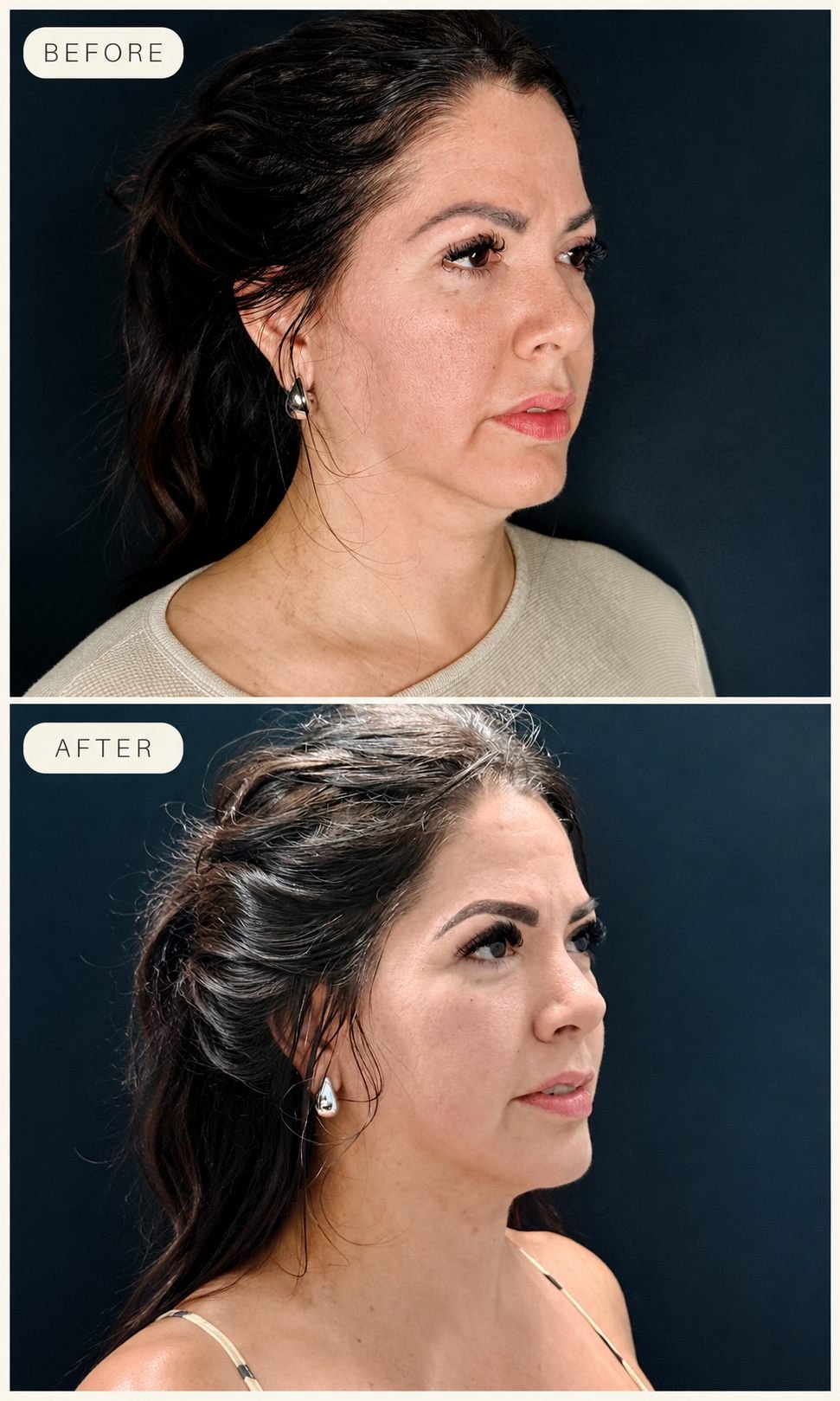 Before and after collage of Endolaser double chin and jawline treatment