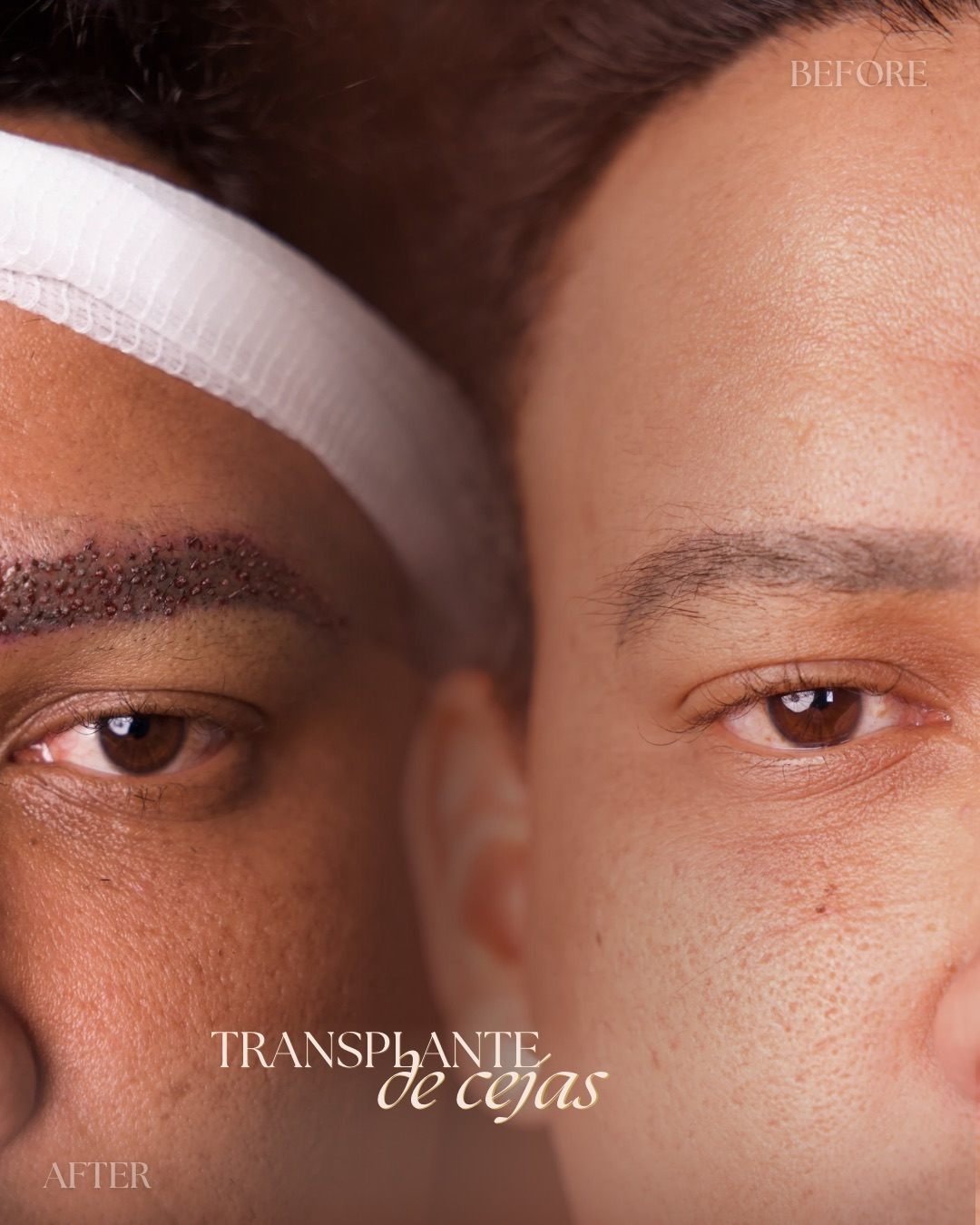 Eyebrow transplant before and after with a natural brow shape restored