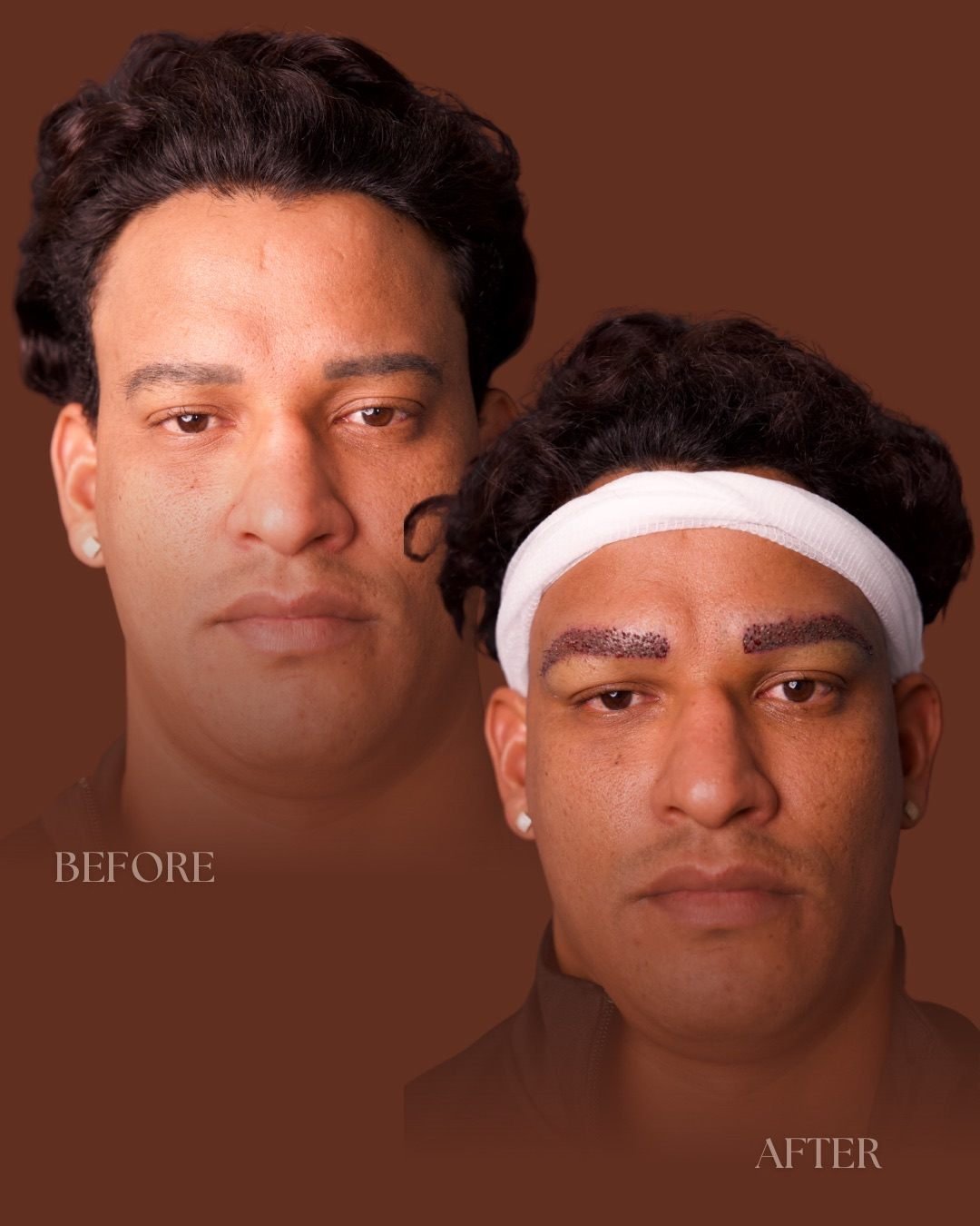 Eyebrow transplant before and after showing restored density at The Edit