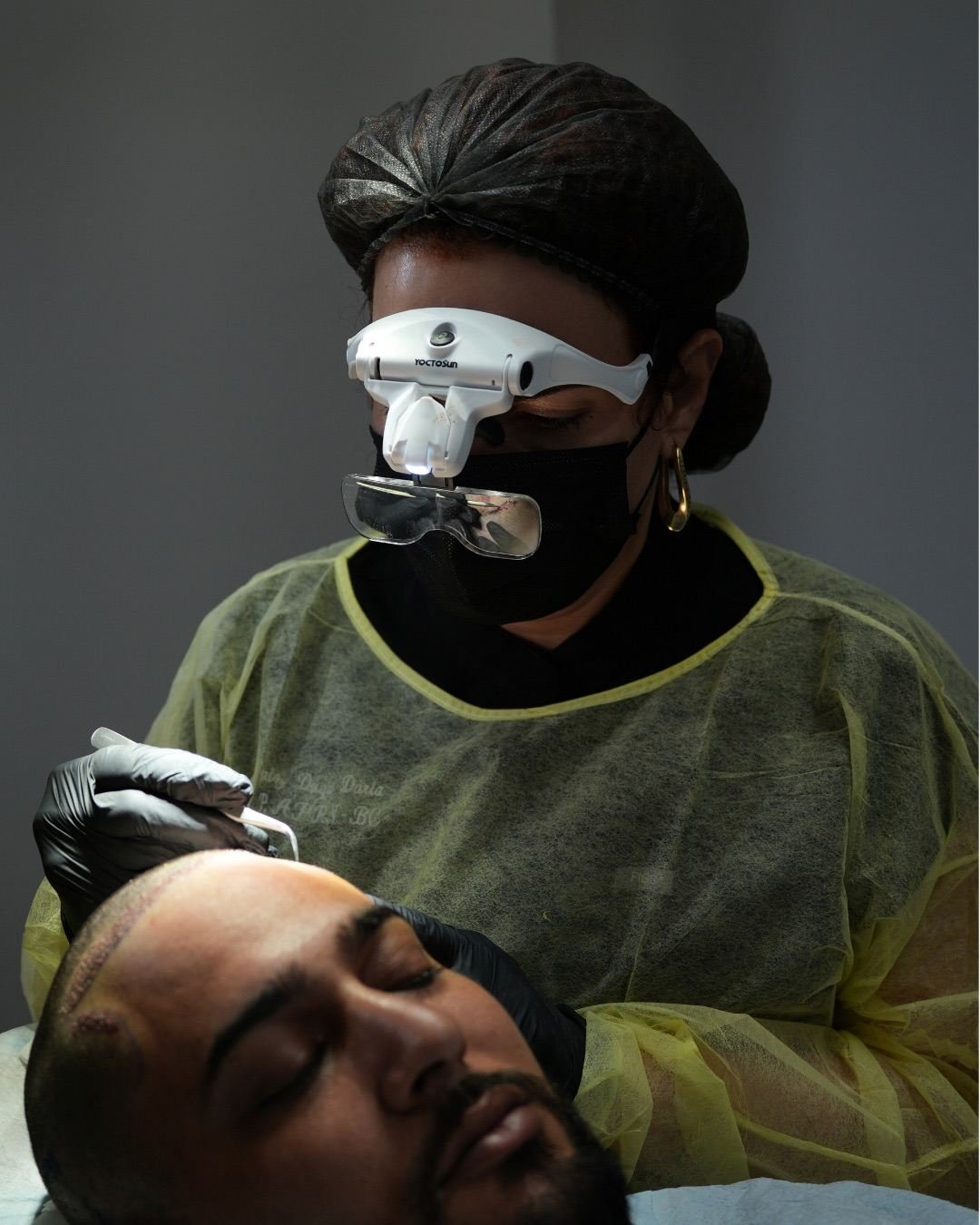 Beatriz Duque performing an FUE hair transplant under magnification at The Edit in Miami
