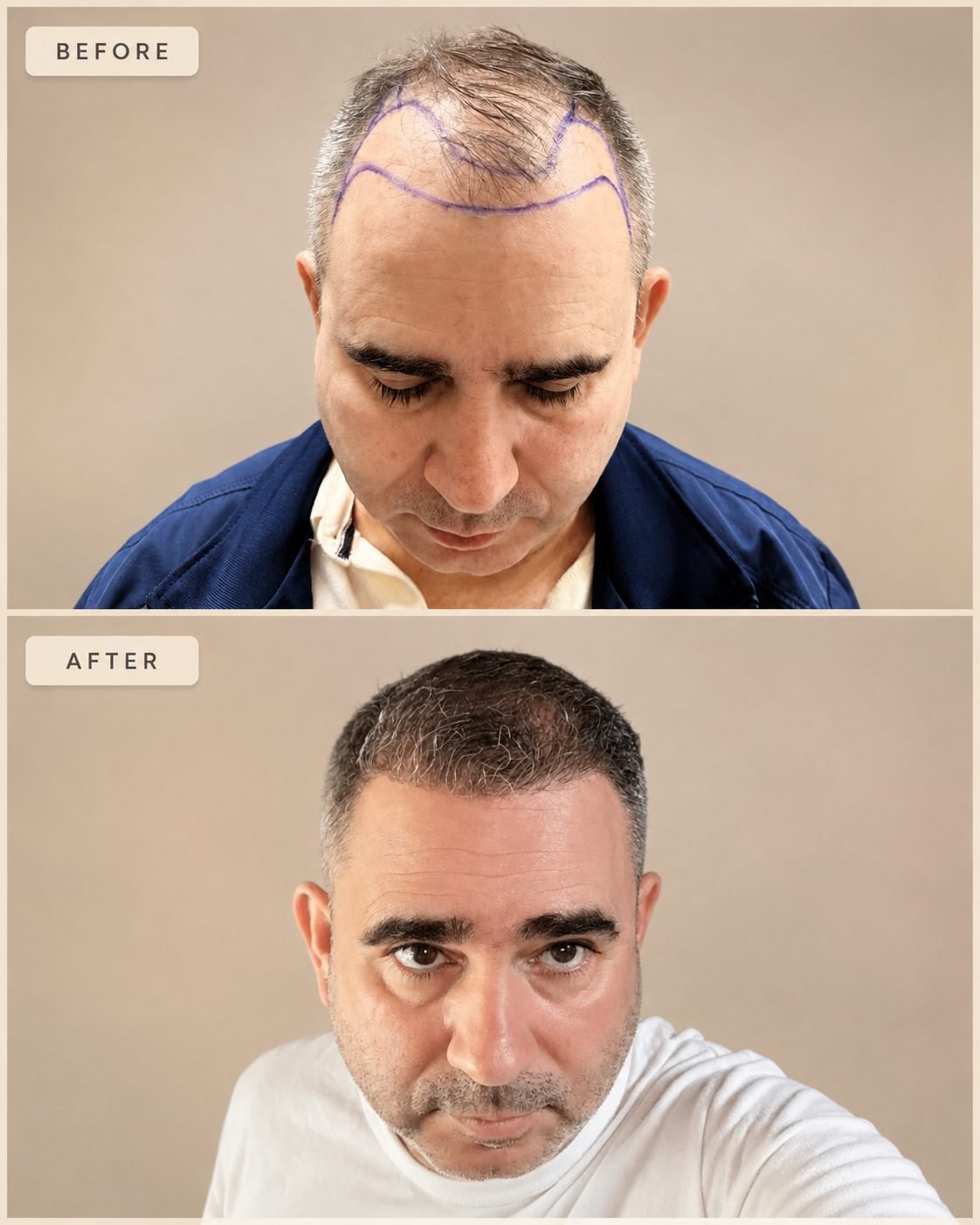 FUE hair transplant patient before the procedure and with visible hairline growth months after