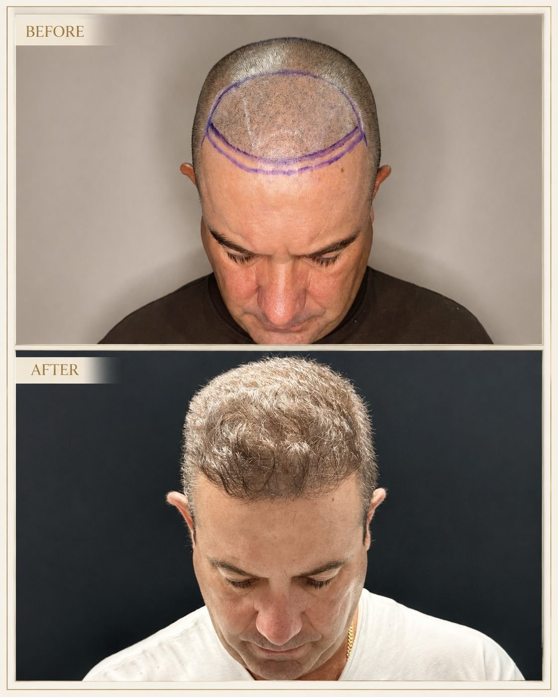 FUE hair transplant growth result showing denser hair months after the procedure at The Edit