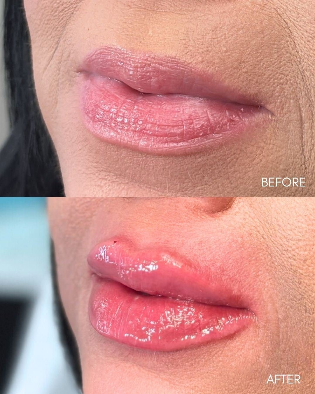 Before and after collage of lip filler improving lip symmetry and border definition