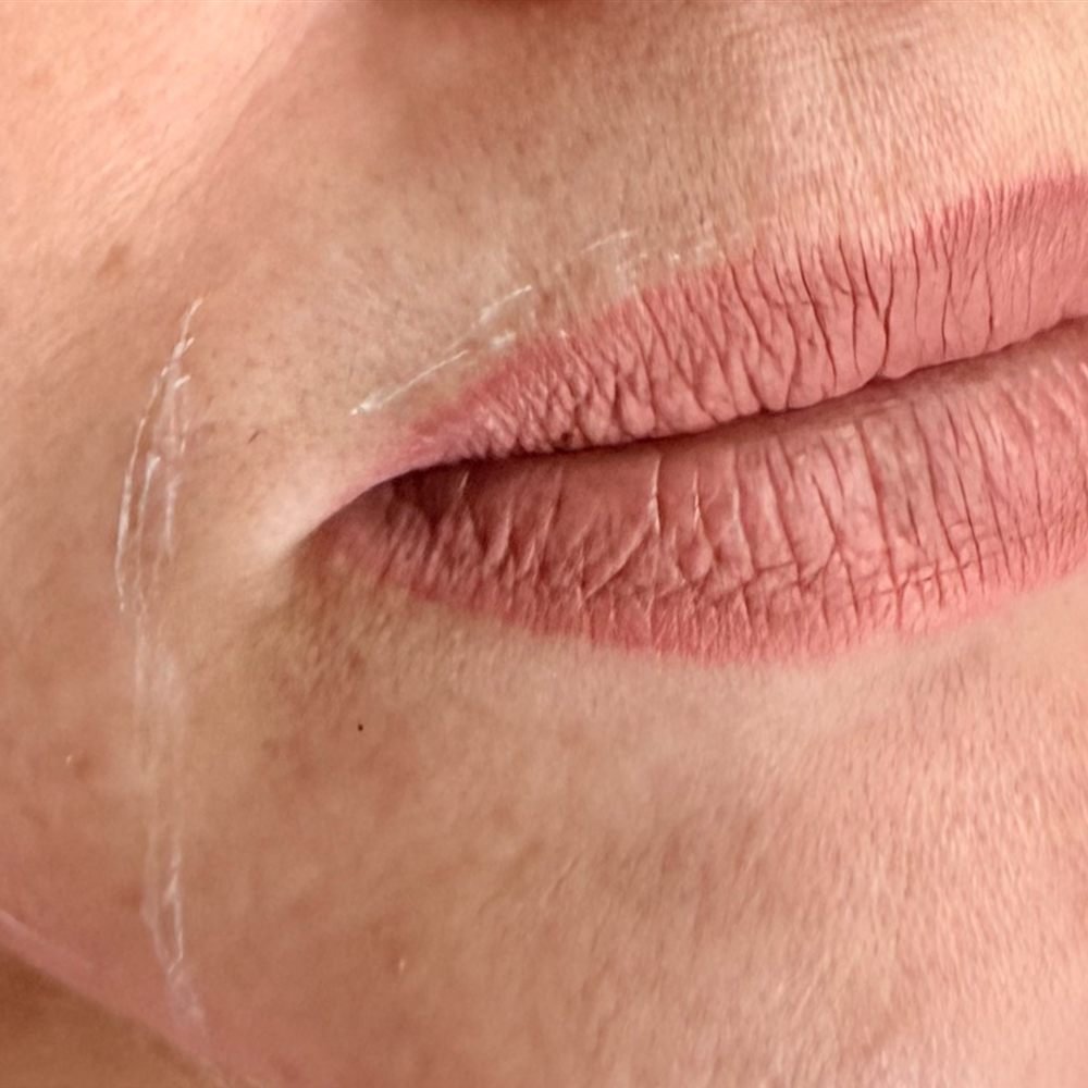 Lips before treatment showing loss of volume and lip lines