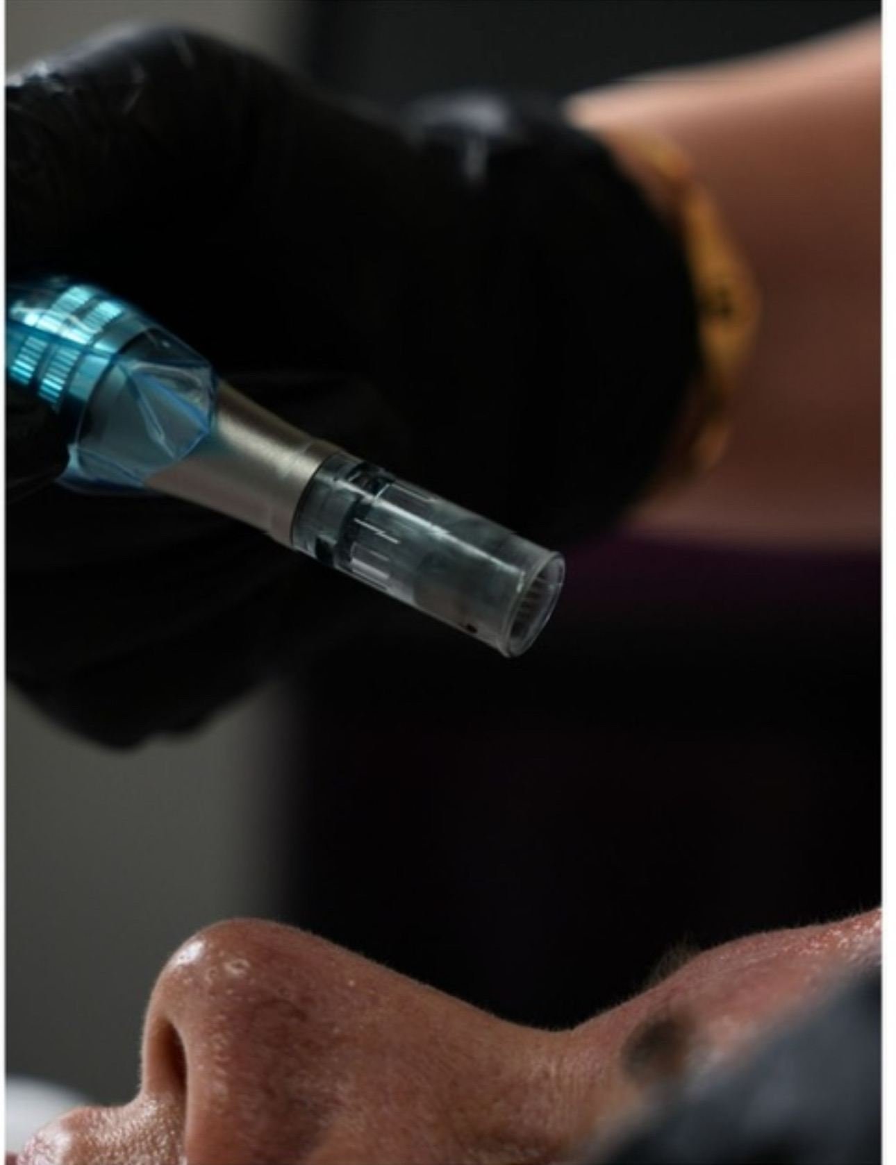 Before and after of microneedling with PRP showing improved skin tone and reduced texture